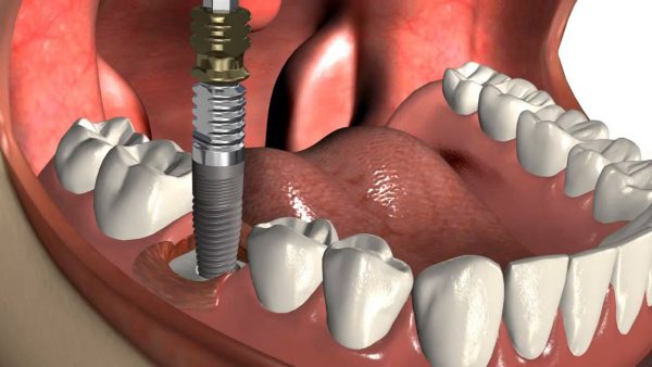 Vous devez connaître l’histoire de l’implant dentaire