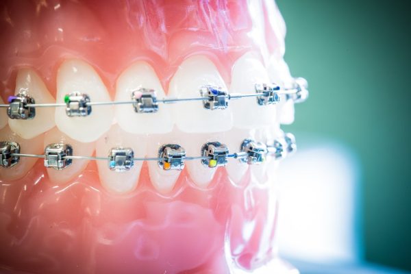 Orthodontics in Woodland Hills